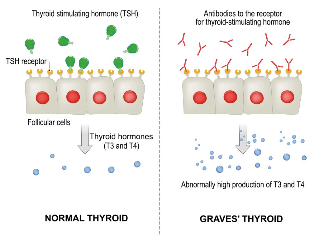 graves-disease-part-1-dr-meei-yeung