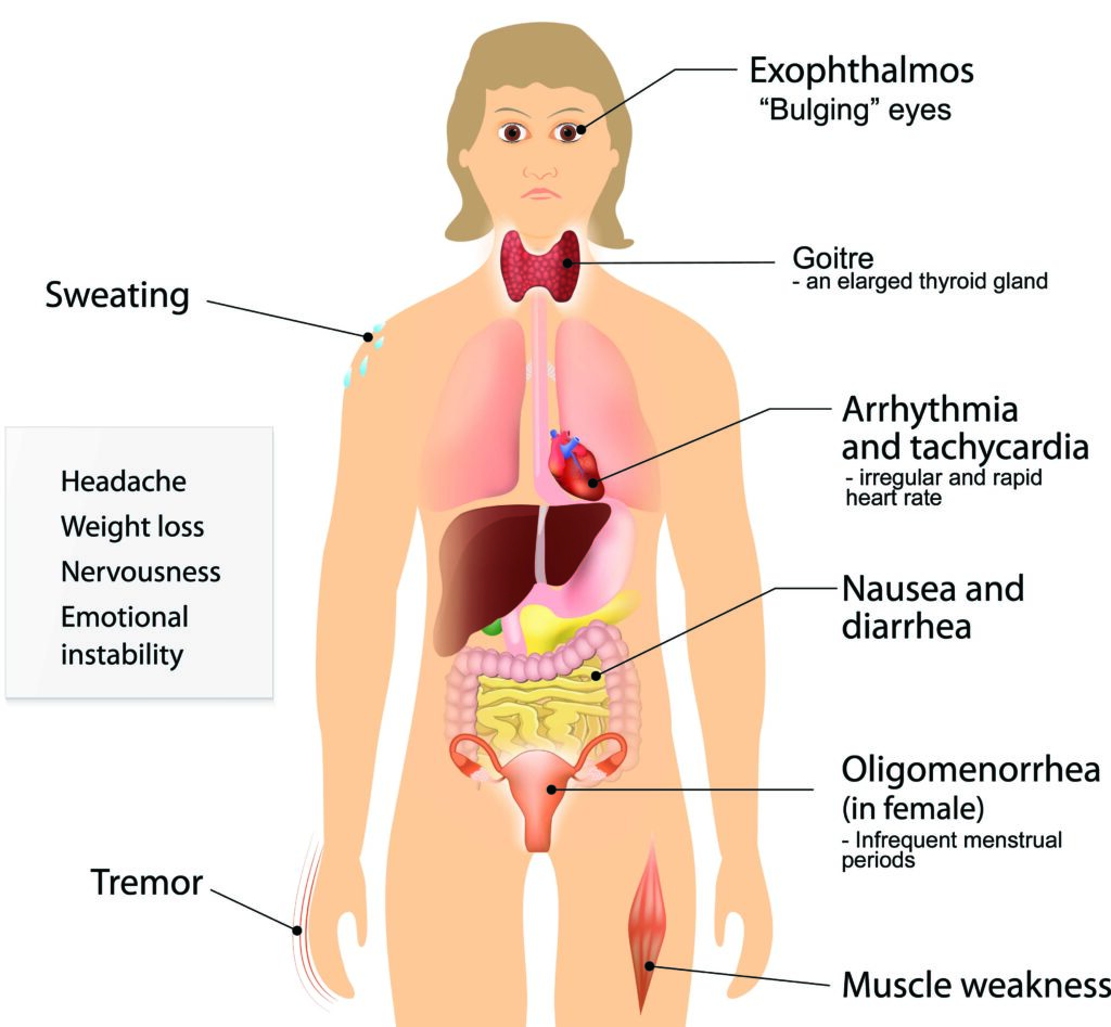 graves-disease-symptoms-causes-treatment-role-of-hyperthyroidism