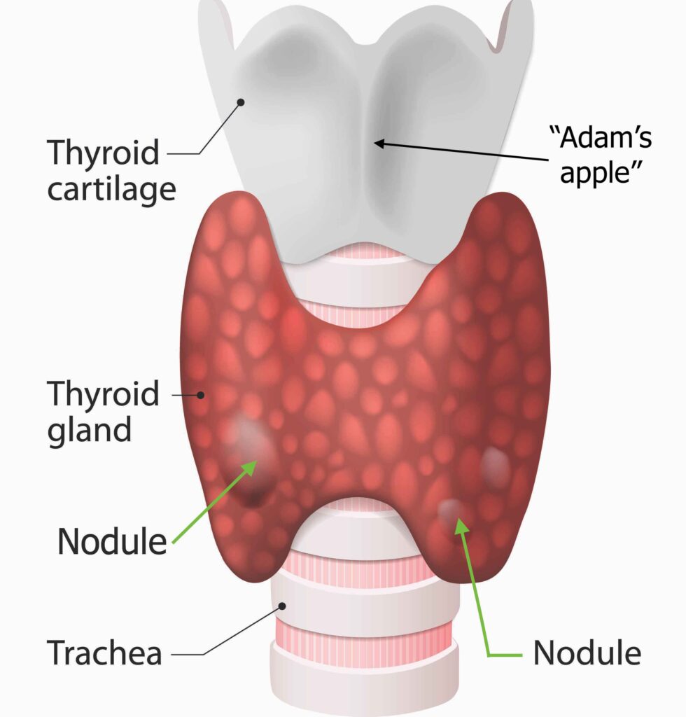 Understanding Thyroid Nodules Symptoms Diagnosis And Treatment Dr